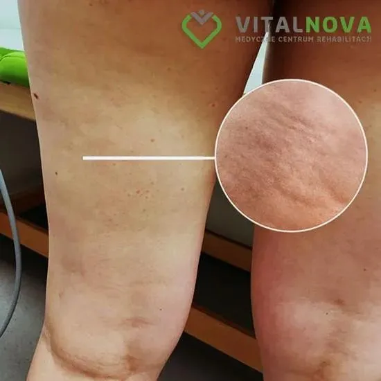 Bieganie czy rower — co naprawdę pomaga na cellulit?