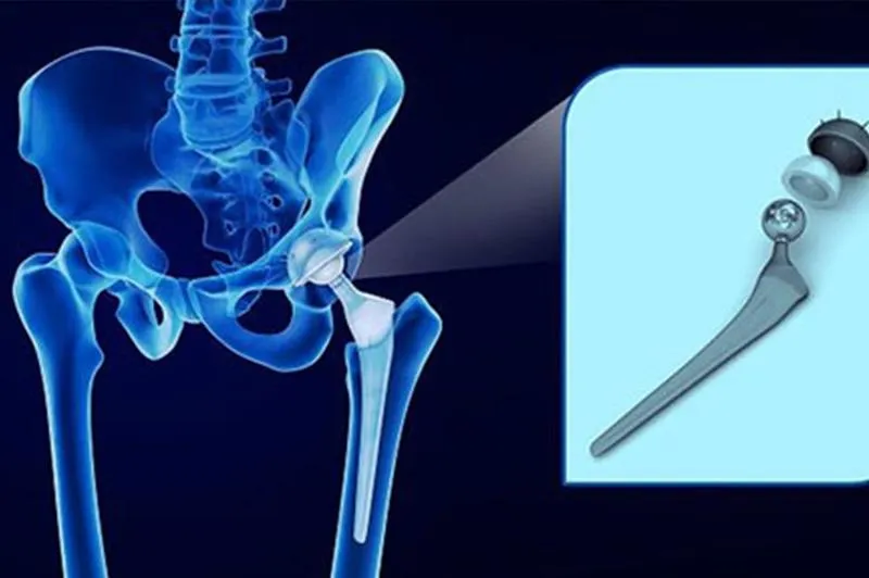 Rehabilitacja po endoprotezie biodra